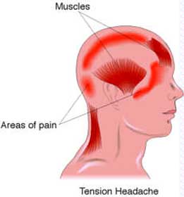 How to Manage Your Tension Headache ?